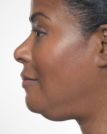 Kybella Treatment Before 1