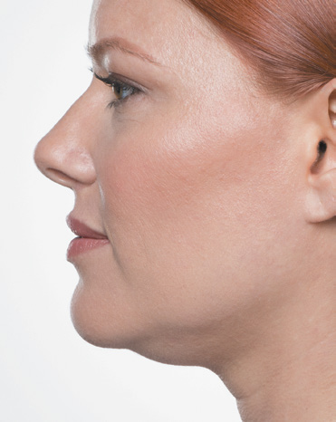 Kybella Treatment Before