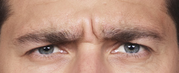 Male Botox Before Photo